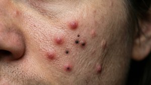 Acne Close-Up Macro