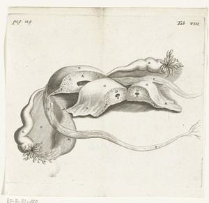 Anatomical depiction of an ectopic pregnancy