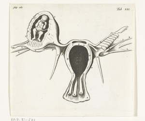 Anatomical depiction of an ectopic pregnancy