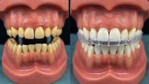 Before After Aligners