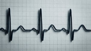 Clinical Chart EKG