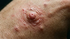 Cystic Acne Study