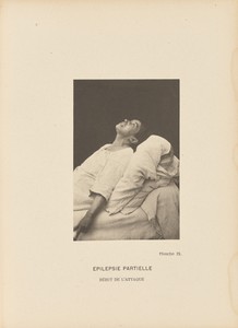Épilepsie Partielle Début de l'Attaque