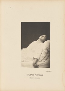 Épilepsie Partielle Période Tonique