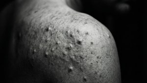 Gritty Scar Texture