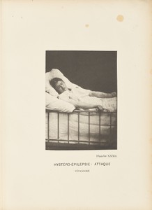 Hystéro-Épilepsie: Attaque Tétanisme