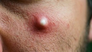 Inflamed Whitehead Macro