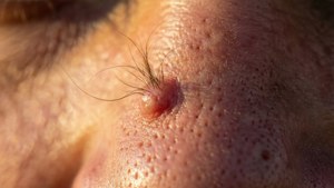 Ingrown Hair Pimple