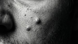 Monochrome Pimple Art