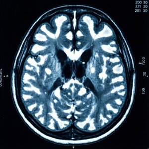 MS Brain Lesions MRI