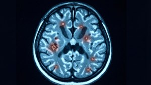 MS Brain MRI Lesions