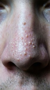 Nose Whiteheads Cluster