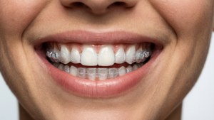 Perfect Smile with Aligners