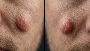 Pimple Formation