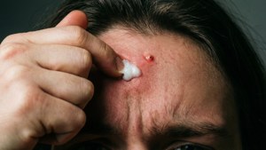 Popping Pimple Action