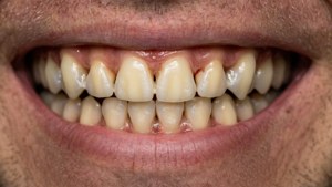 Progress Teeth Aligners