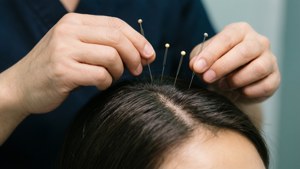 Scalp Acupuncture Adjustment