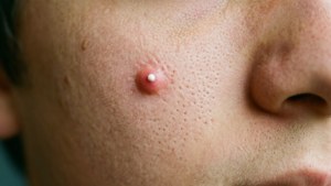 Single Pimple Close-Up
